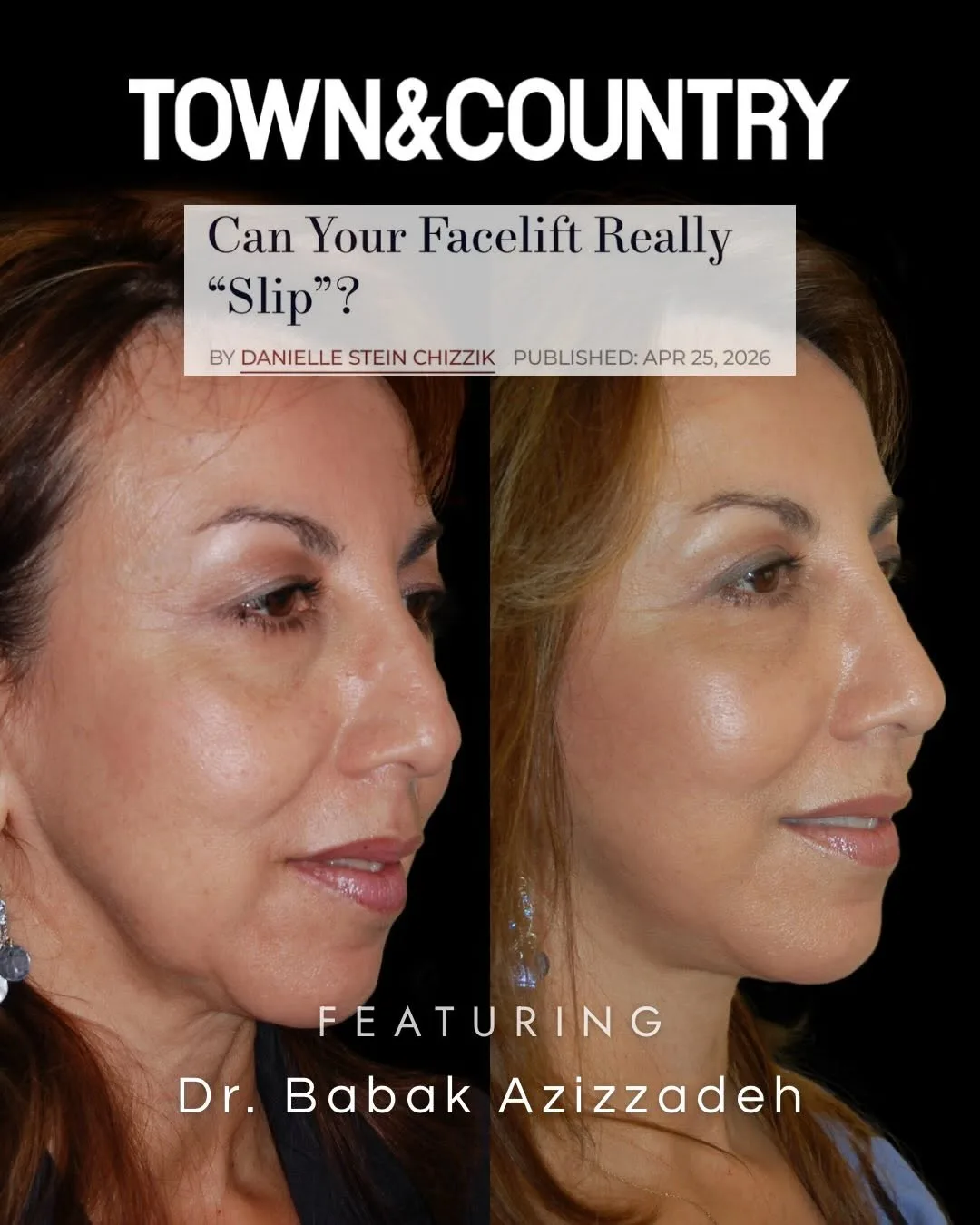 Before and after deep plane facelift — 52-year-old woman, right profile view, 12mo post-op by Dr. Babak Azizzadeh