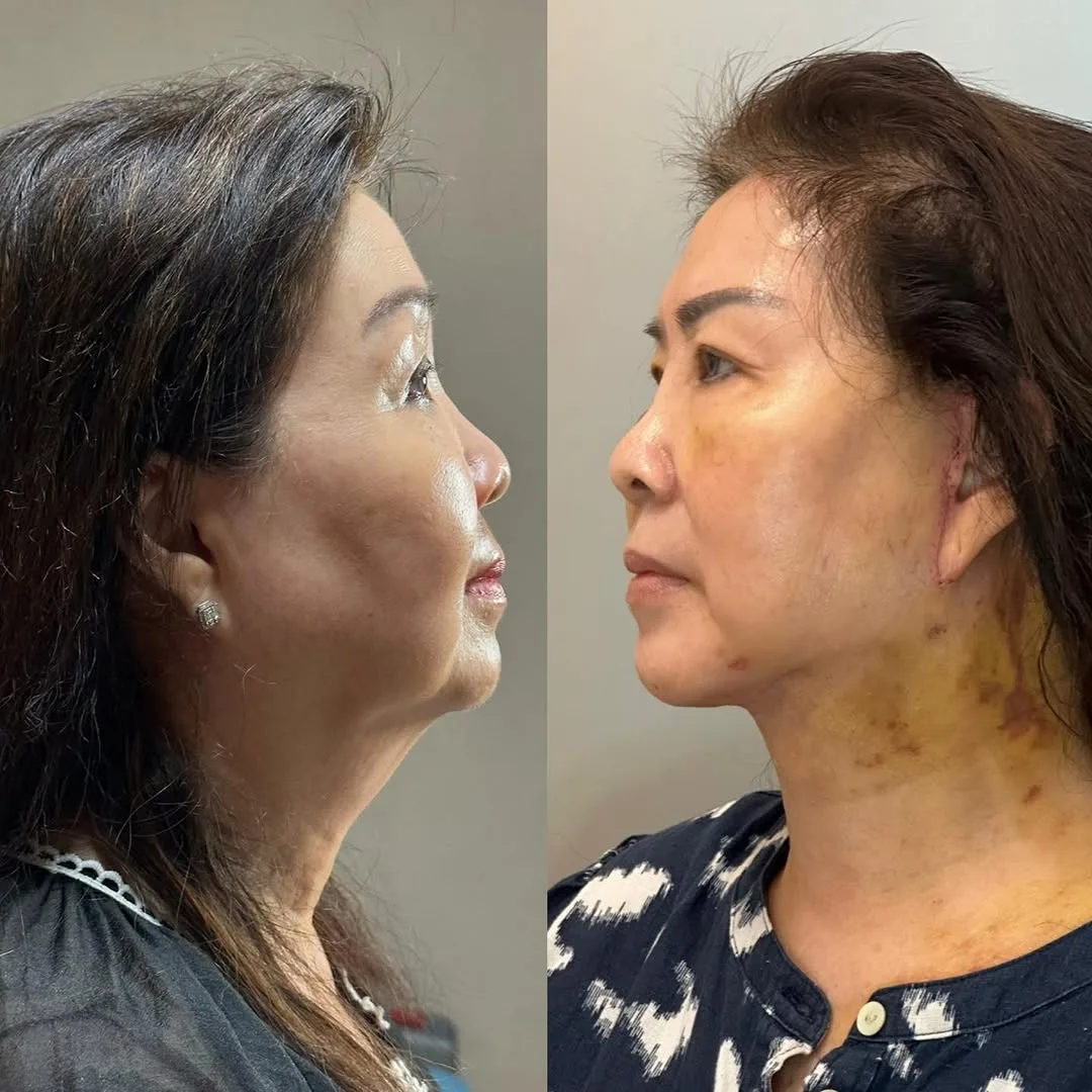Before and after — Dr. Bambang Wicaksono