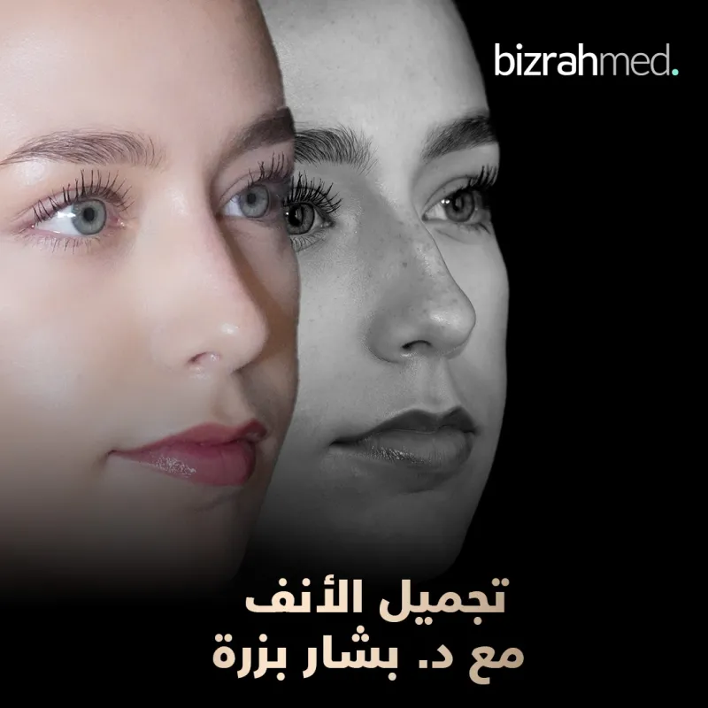 Before and after — Dr. Bashar Bizrah