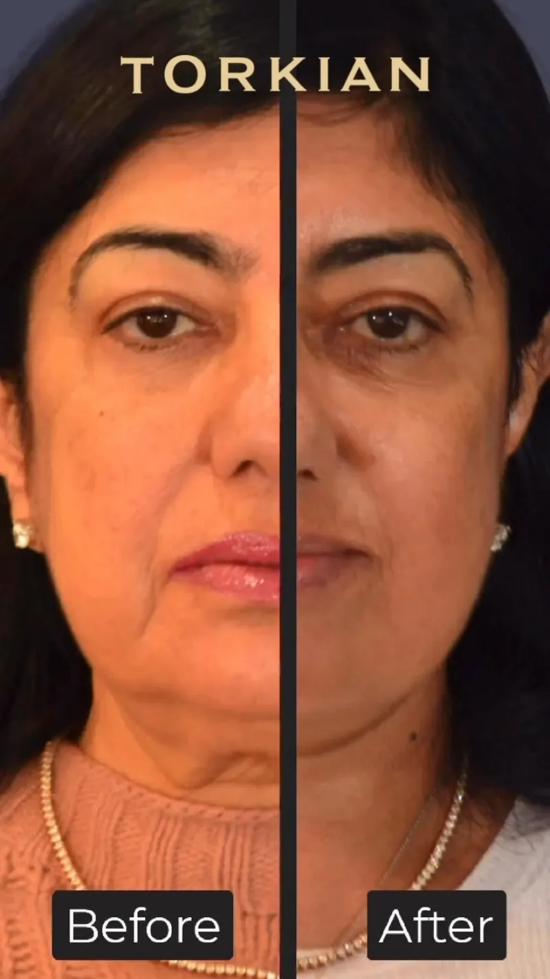 Before and after: Dr. Behrooz Torkian