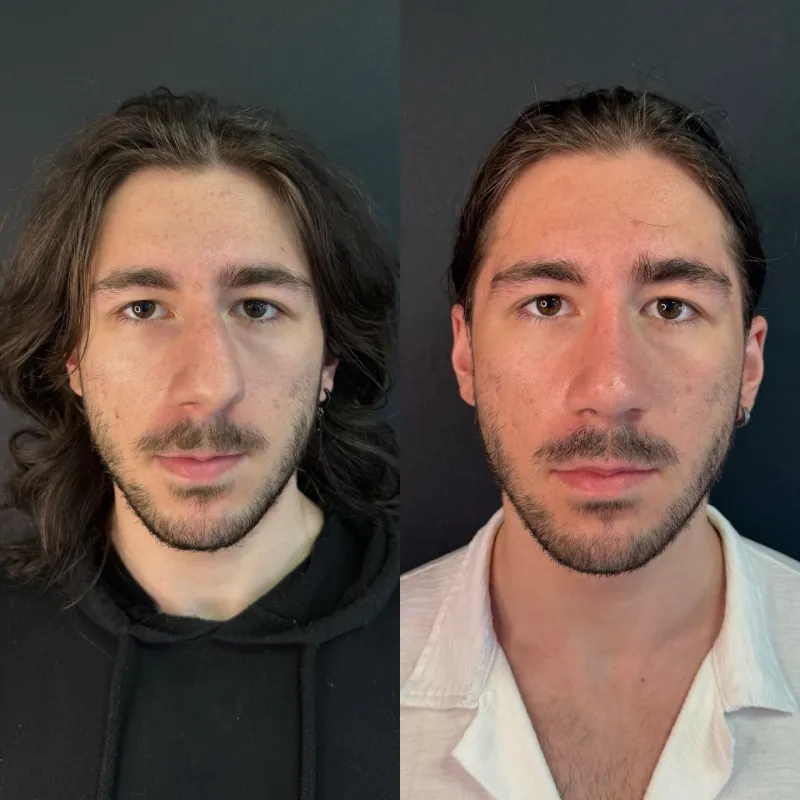 Before and after — Dr. Bekir Gümüşlü