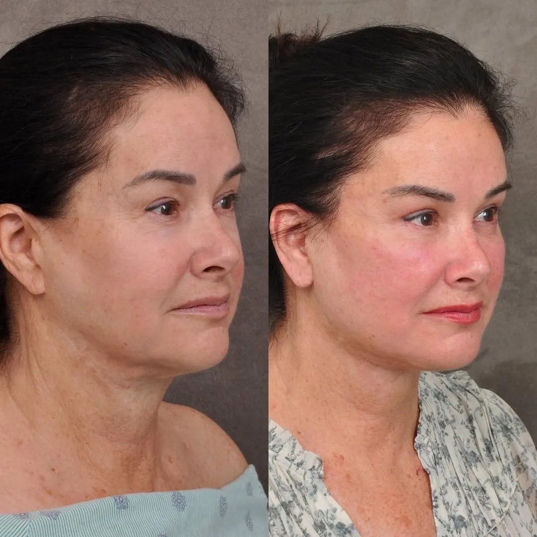 Before and after deep plane facelift — 52-year-old woman, left profile view, 6mo post-op by Dr. Ben Talei