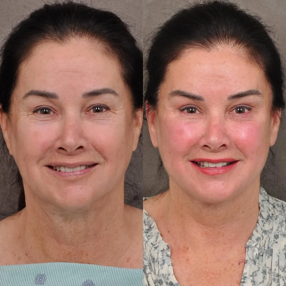 Before and after deep plane facelift — 55-year-old woman, frontal view, 4mo post-op by Dr. Ben Talei