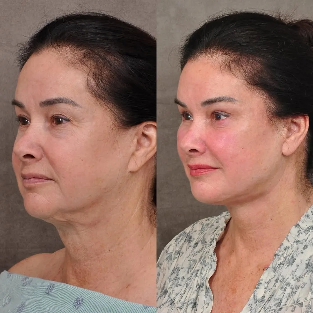 Before and after deep plane facelift — 55-year-old woman, oblique left view, 6mo post-op by Dr. Ben Talei