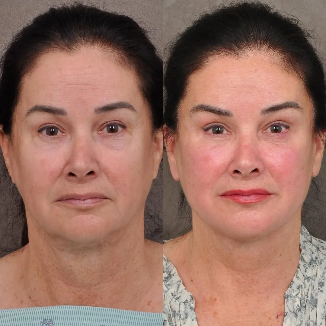 Before and after deep plane facelift — 55-year-old woman, frontal view, 4mo post-op by Dr. Ben Talei