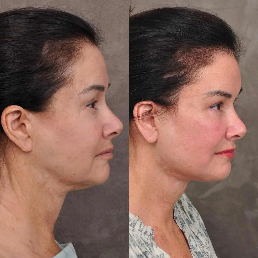 Before and after deep plane facelift — 48-year-old woman, right profile view, 6mo post-op by Dr. Ben Talei