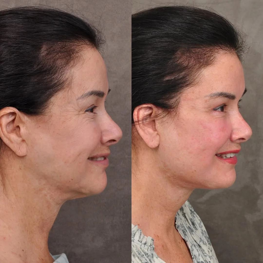 Before and after deep plane facelift — 55-year-old woman, left profile view, 6mo post-op by Dr. Ben Talei