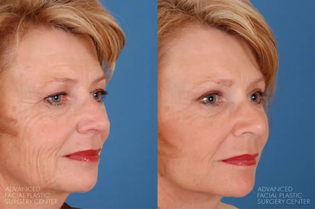 Before and after — Dr. Benjamin Bassichis
