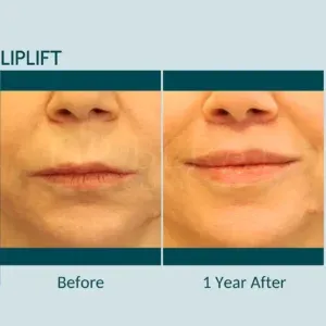 Before and after deep plane facelift — 60-year-old woman, frontal view, 12mo post-op by Dr. Berat Çiğdem