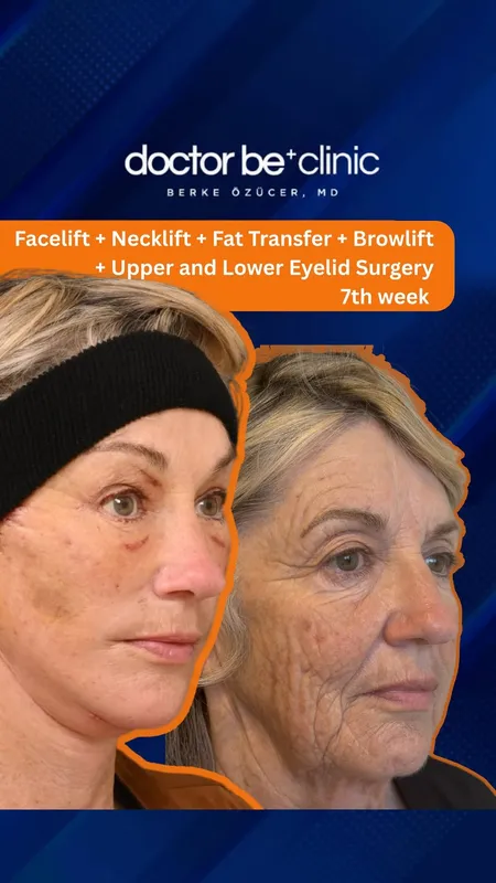 Before and after — Dr. Berke Özücer
