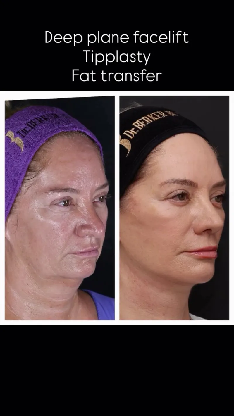 Before and after: Dr. Berker Büyükgüral