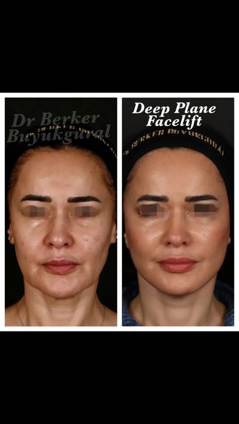 Before and after: Dr. Berker Büyükgüral
