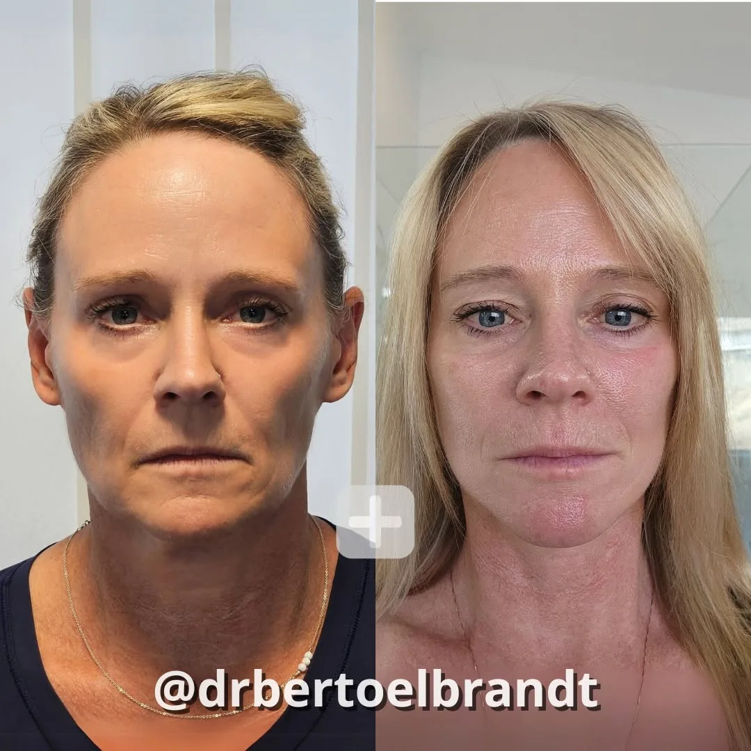 Before and after — Dr. Bert Oelbrandt