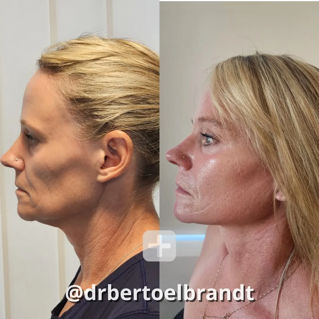 Before and after — Dr. Bert Oelbrandt