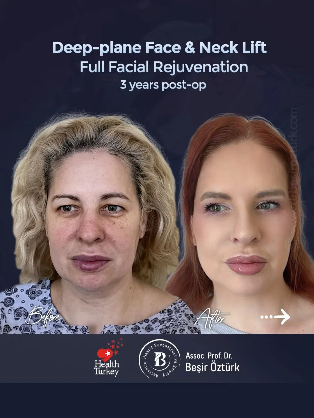 Before and after — Dr. Beşir Öztürk