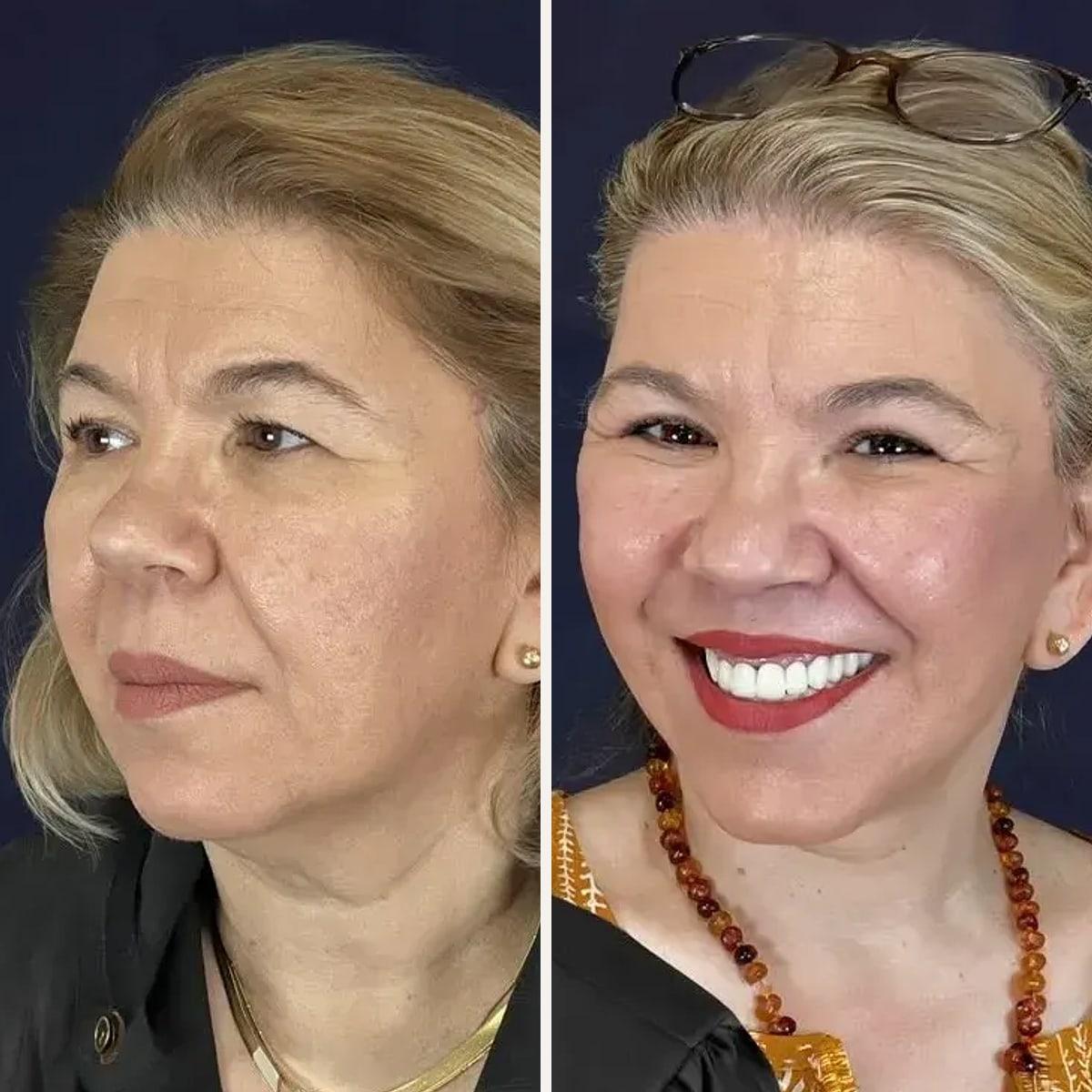 Przed i po: Dr. Beşir Öztürk