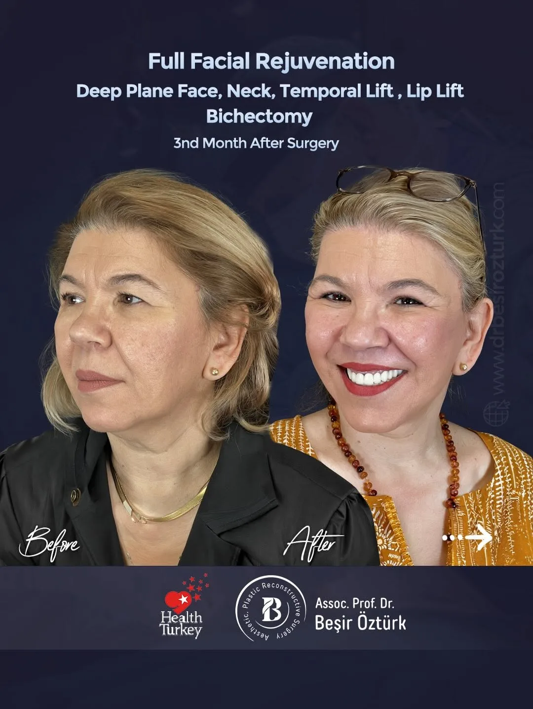 Before and after — Dr. Beşir Öztürk