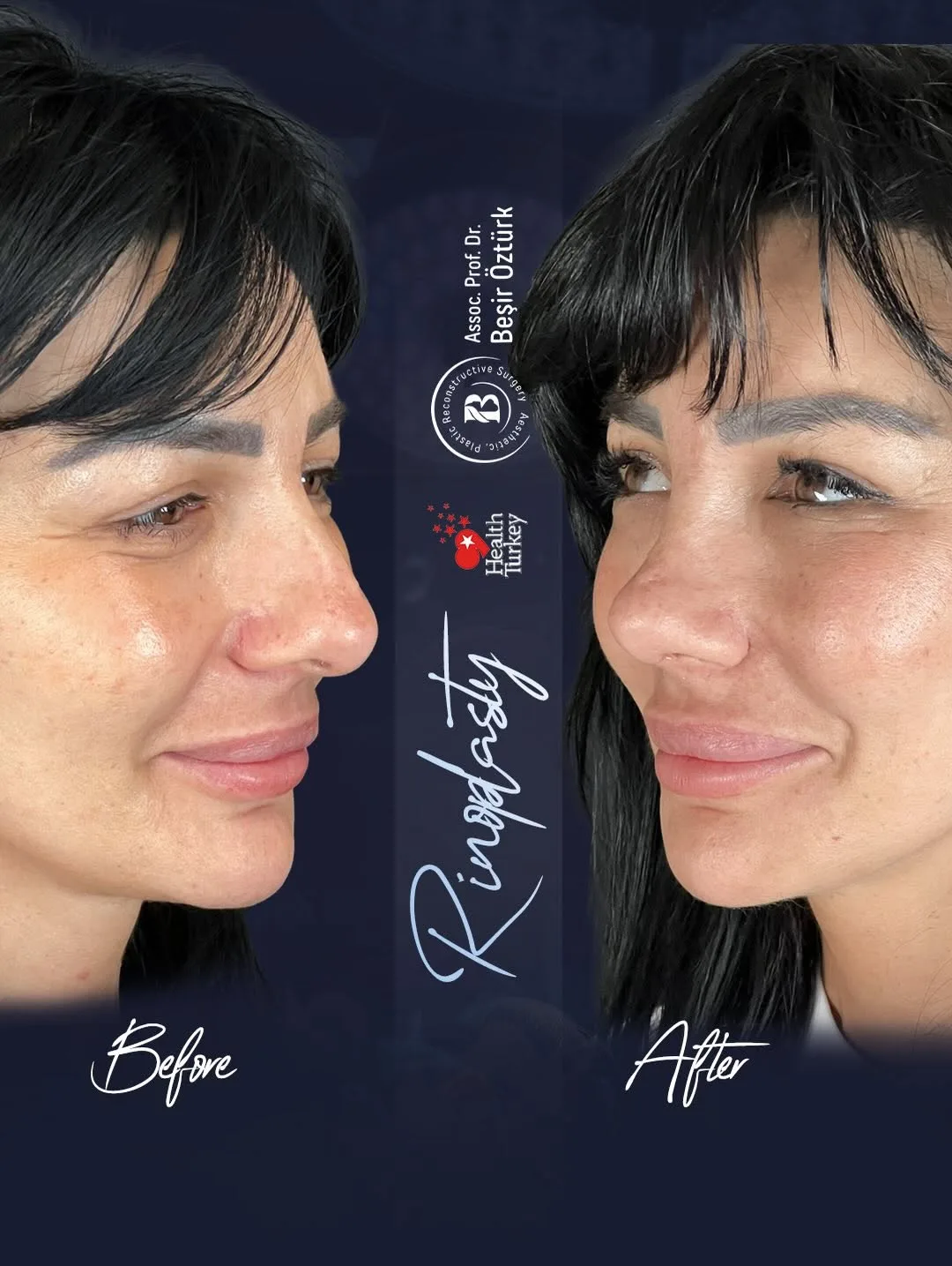 Before and after — Dr. Beşir Öztürk