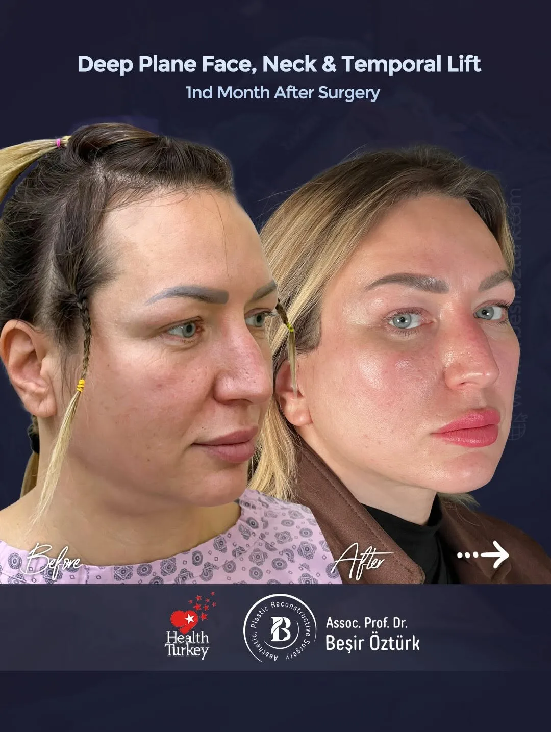 Before and after — Dr. Beşir Öztürk