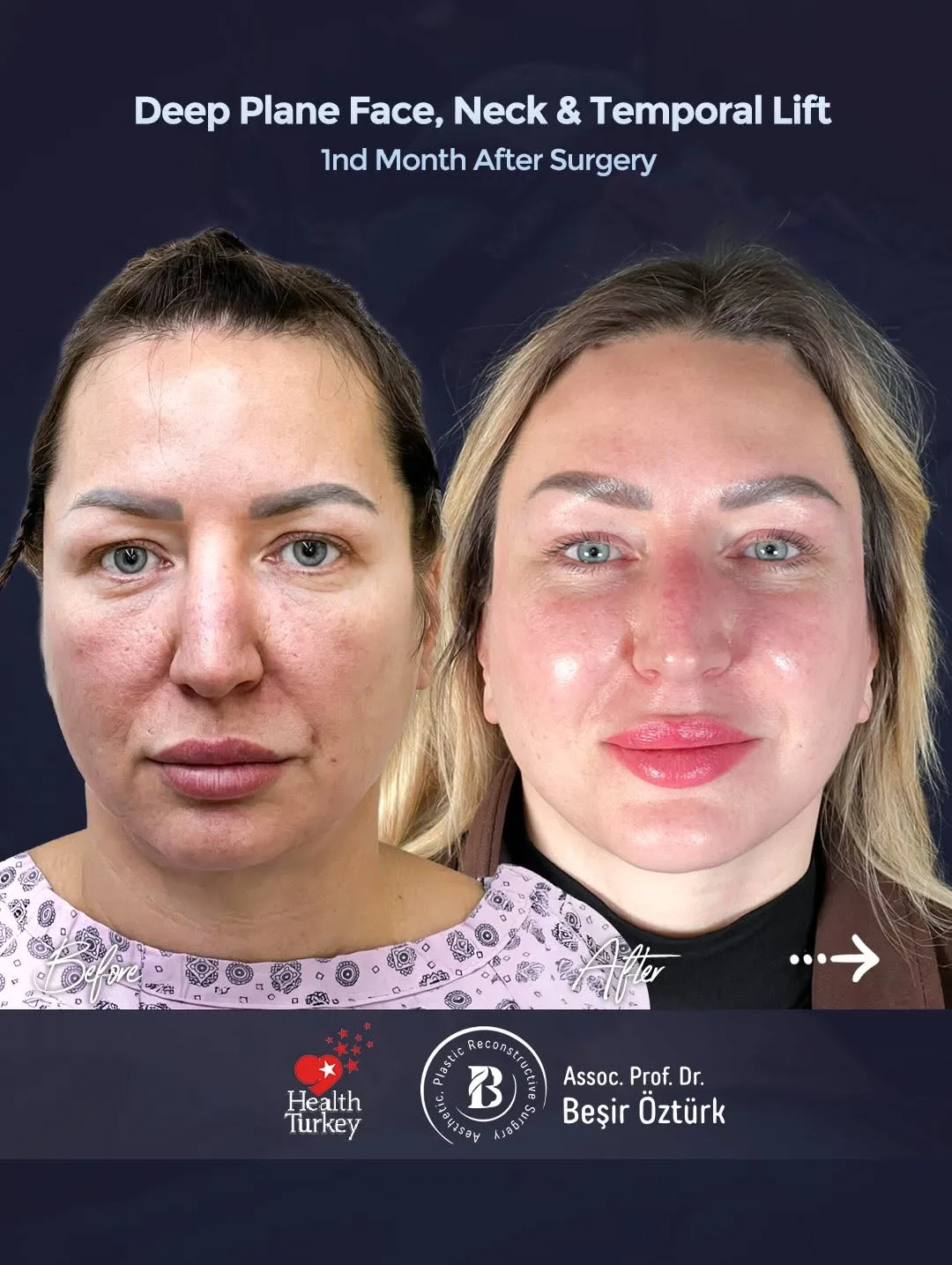 Before and after — Dr. Beşir Öztürk