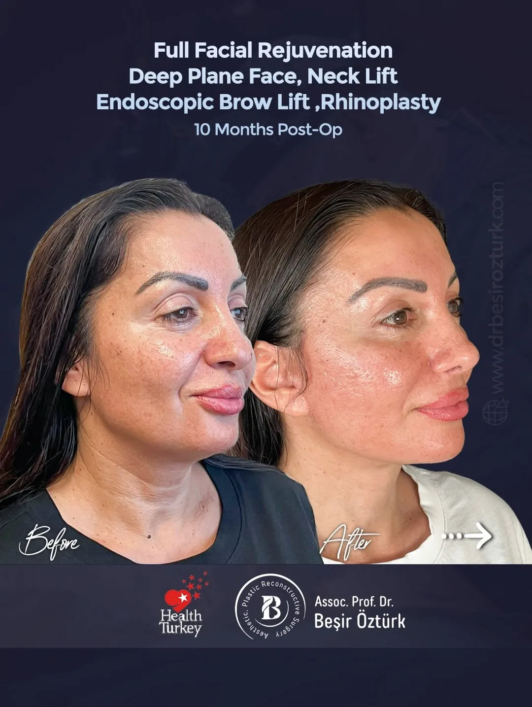 Before and after — Dr. Beşir Öztürk