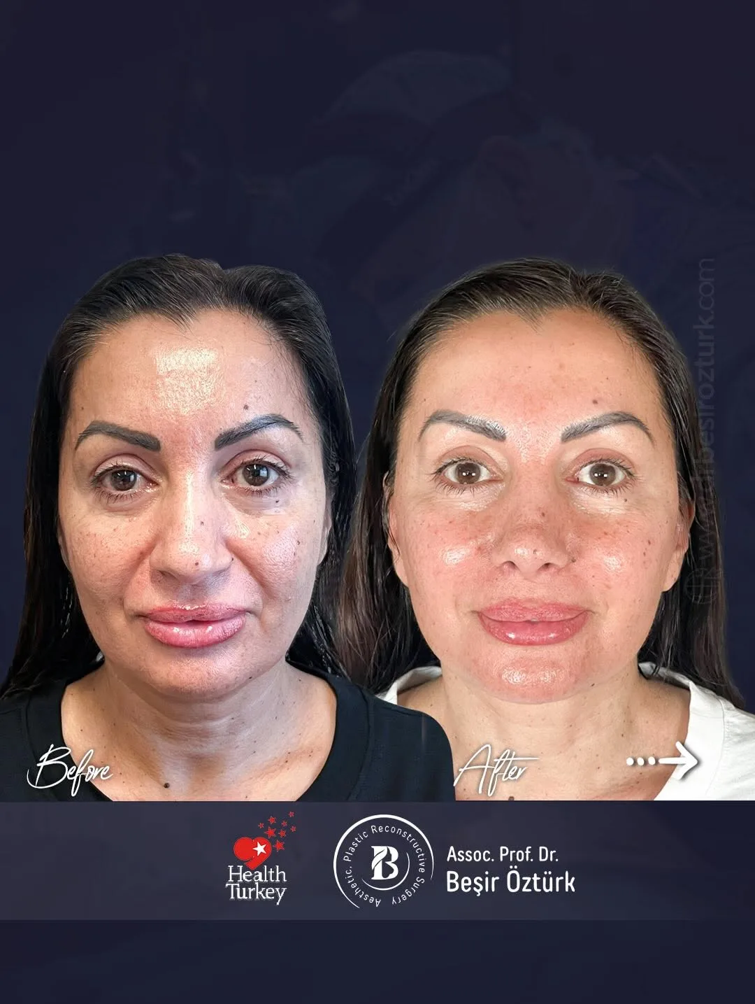 Before and after — Dr. Beşir Öztürk