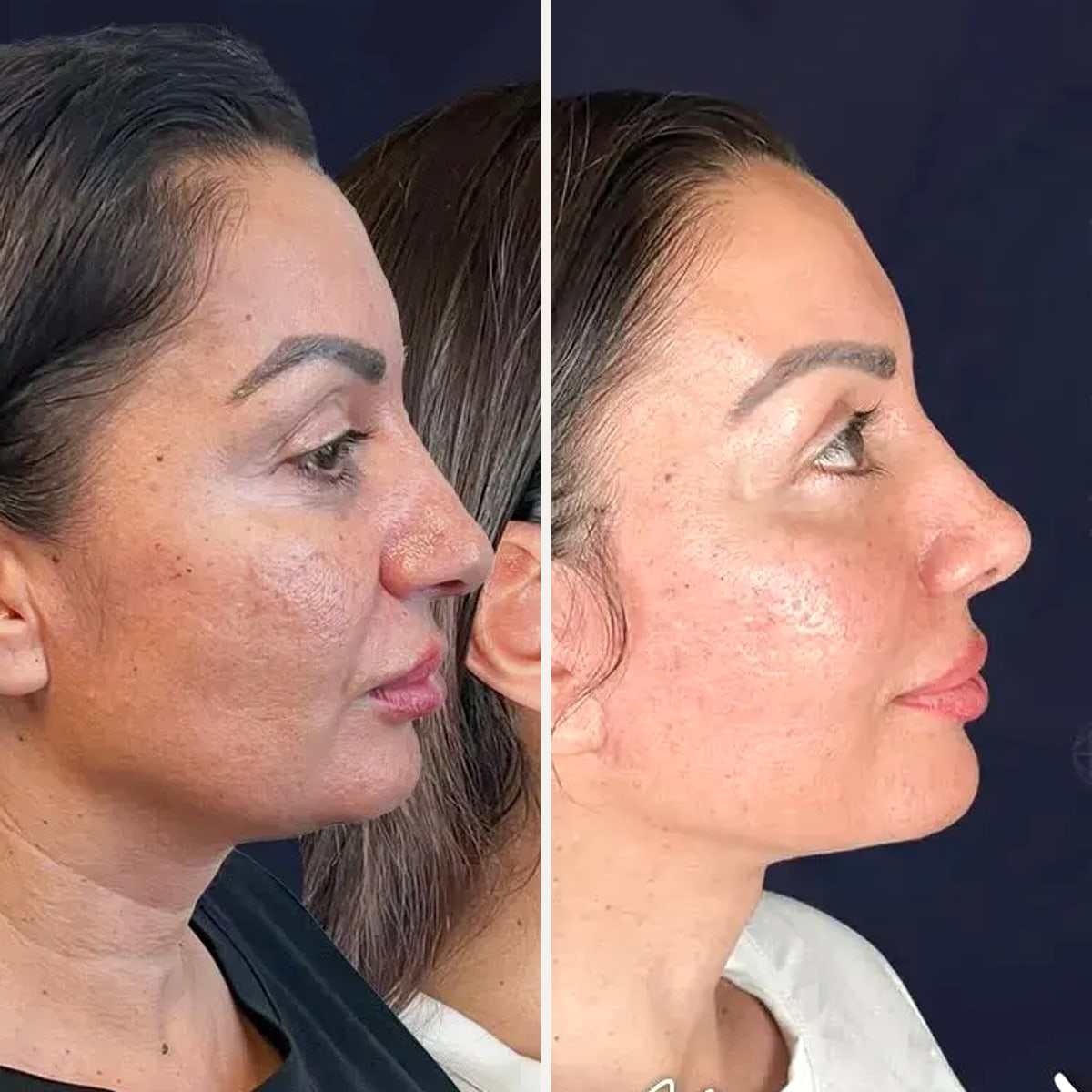 Przed i po: Dr. Beşir Öztürk