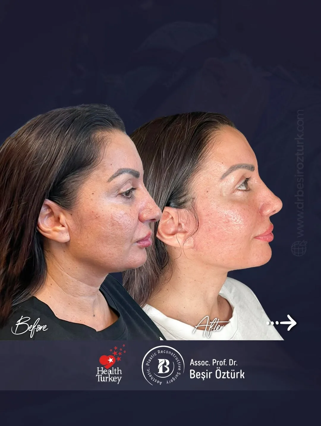 Before and after — Dr. Beşir Öztürk
