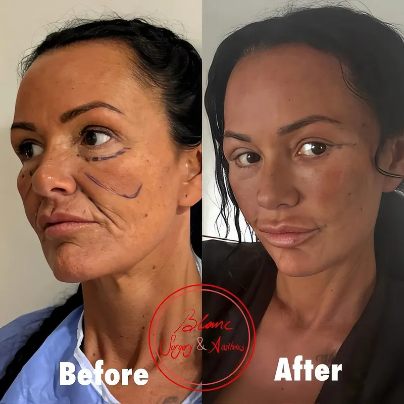 Before and after — Dr. Bilgehan Sarı