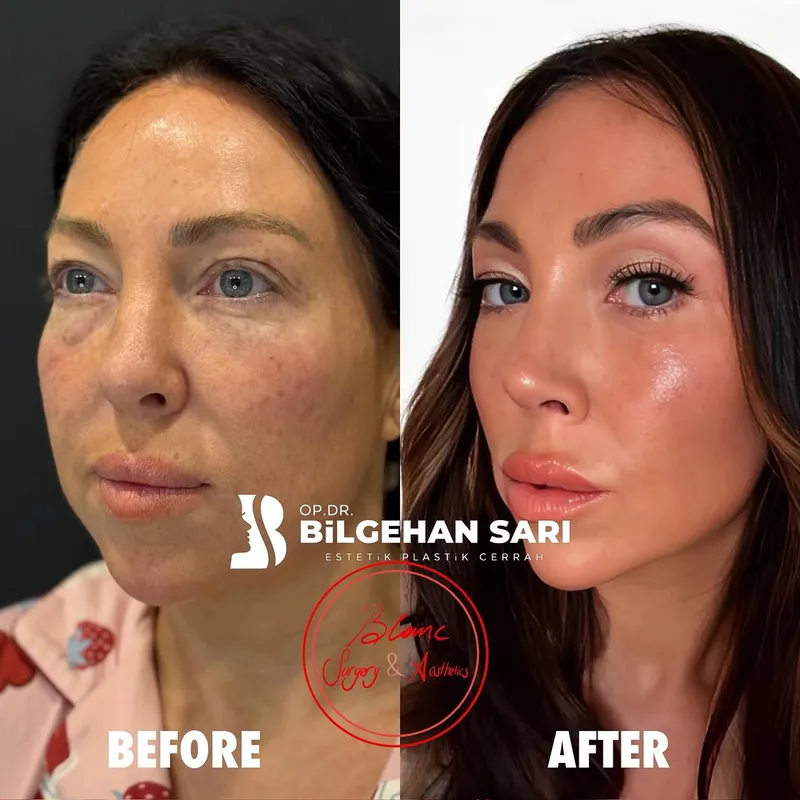 Before and after — Dr. Bilgehan Sarı