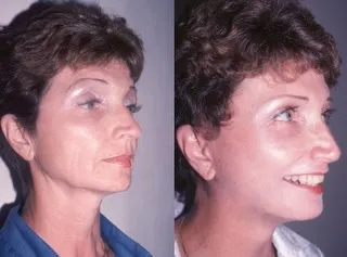 Before and after — Dr. Borko Djordjevic