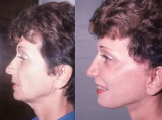 Before and after — Dr. Borko Djordjevic