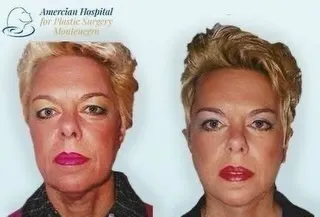 Before and after — Dr. Borko Djordjevic