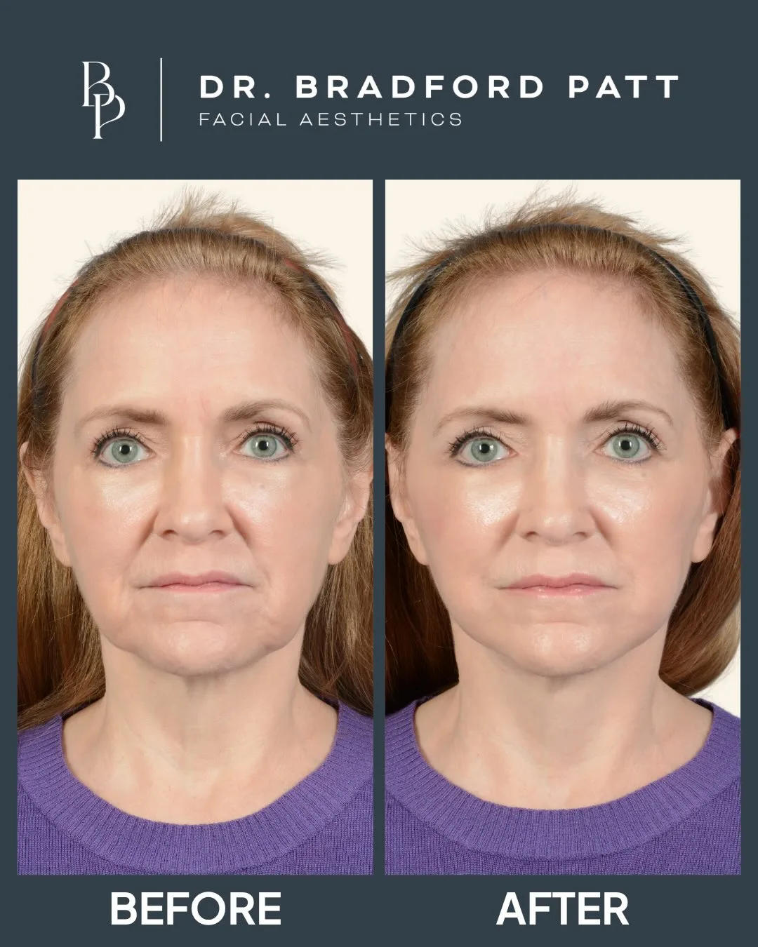 Before and after — Dr. Bradley Patt