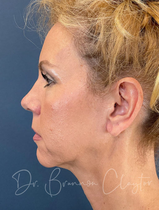 Before deep plane facelift — 52-year-old woman, frontal view, 6mo post-op by Dr. Brannon Claytor