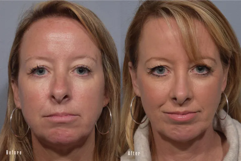 Before and after — Dr. Brian Bassiri-Tehrani