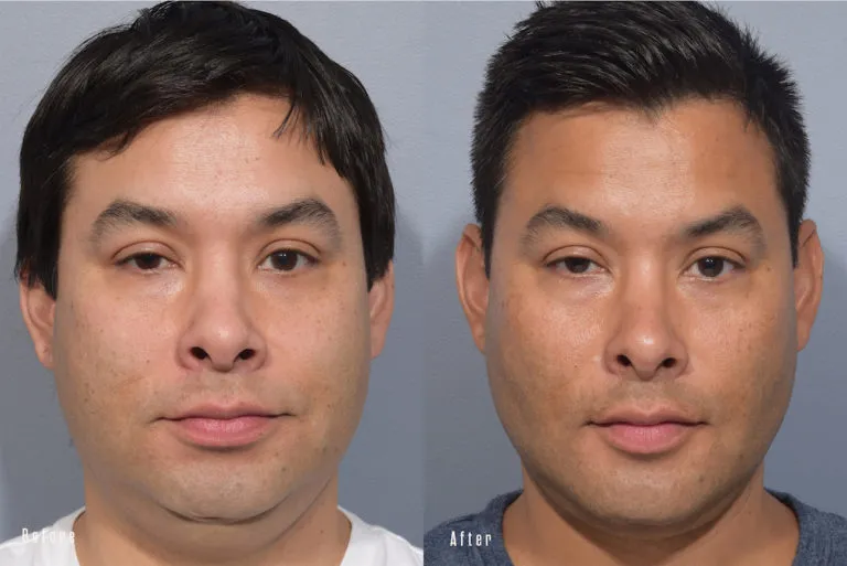 Before and after — Dr. Brian Bassiri-Tehrani