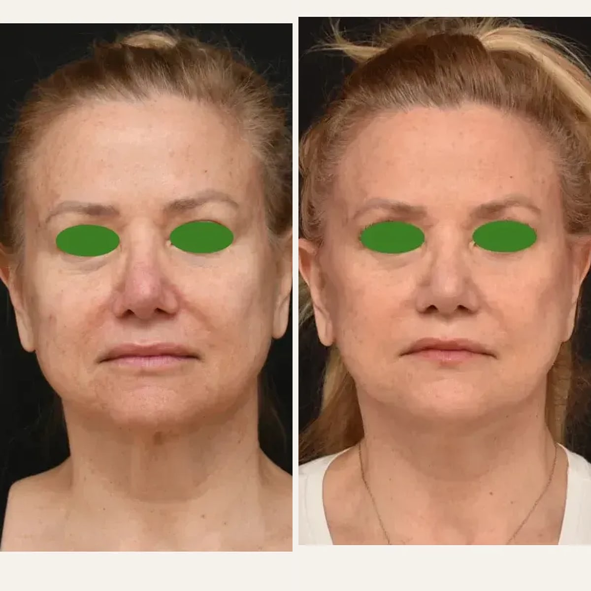 Before & After - Deep Plane Facelift by Dr. Brian Dickinson