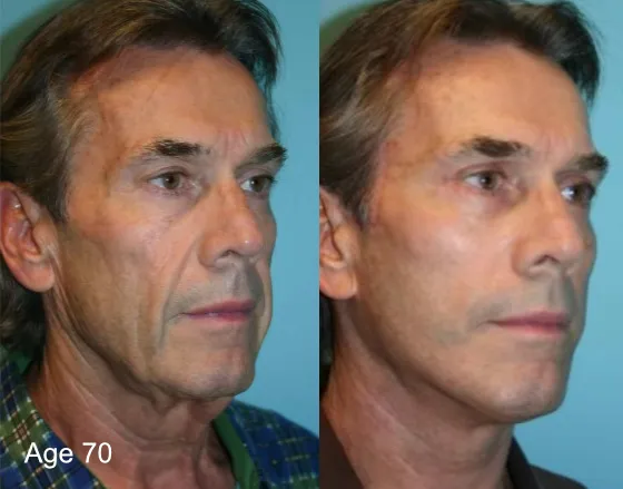 Before and after deep plane facelift — 70-year-old man, three-quarter view, 12mo post-op by Dr. Brian Dorner