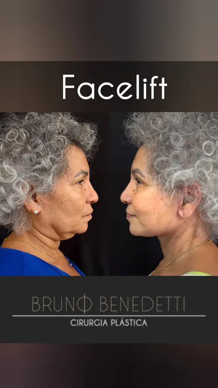 Before and after — Dr. Bruno Benedetti