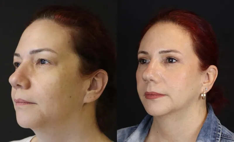 Before and after deep plane facelift — -1-year-old patient, frontal view by Dr. Bükem Cüce