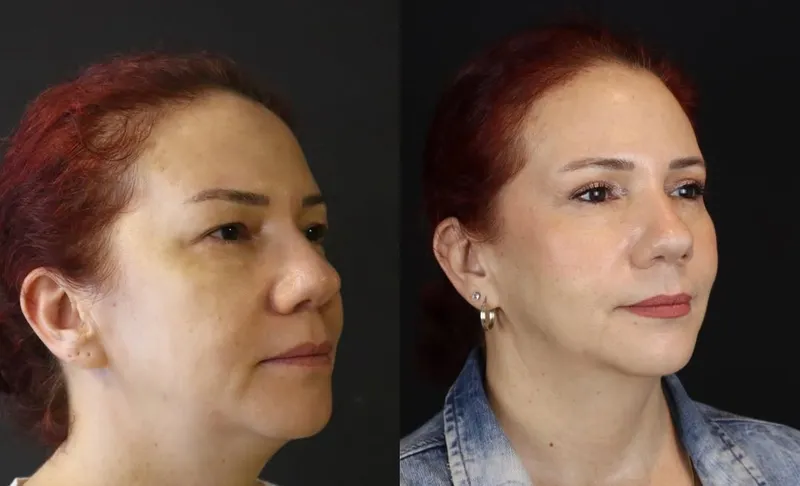 Before and after deep plane facelift — -1-year-old patient, frontal view by Dr. Bükem Cüce