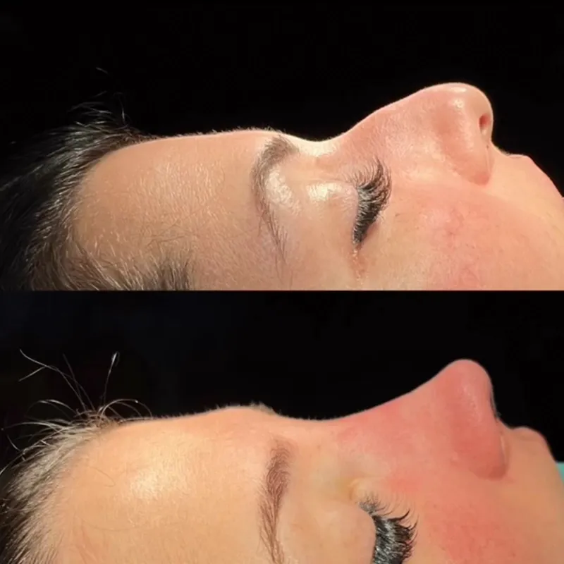 Before and after deep plane facelift — 30-year-old woman, right profile view, 1mo post-op by Dr. Bülent Demir