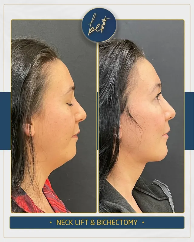 Before and after deep plane facelift — -1-year-old patient, frontal view by Dr. Burak Ergün Tatar