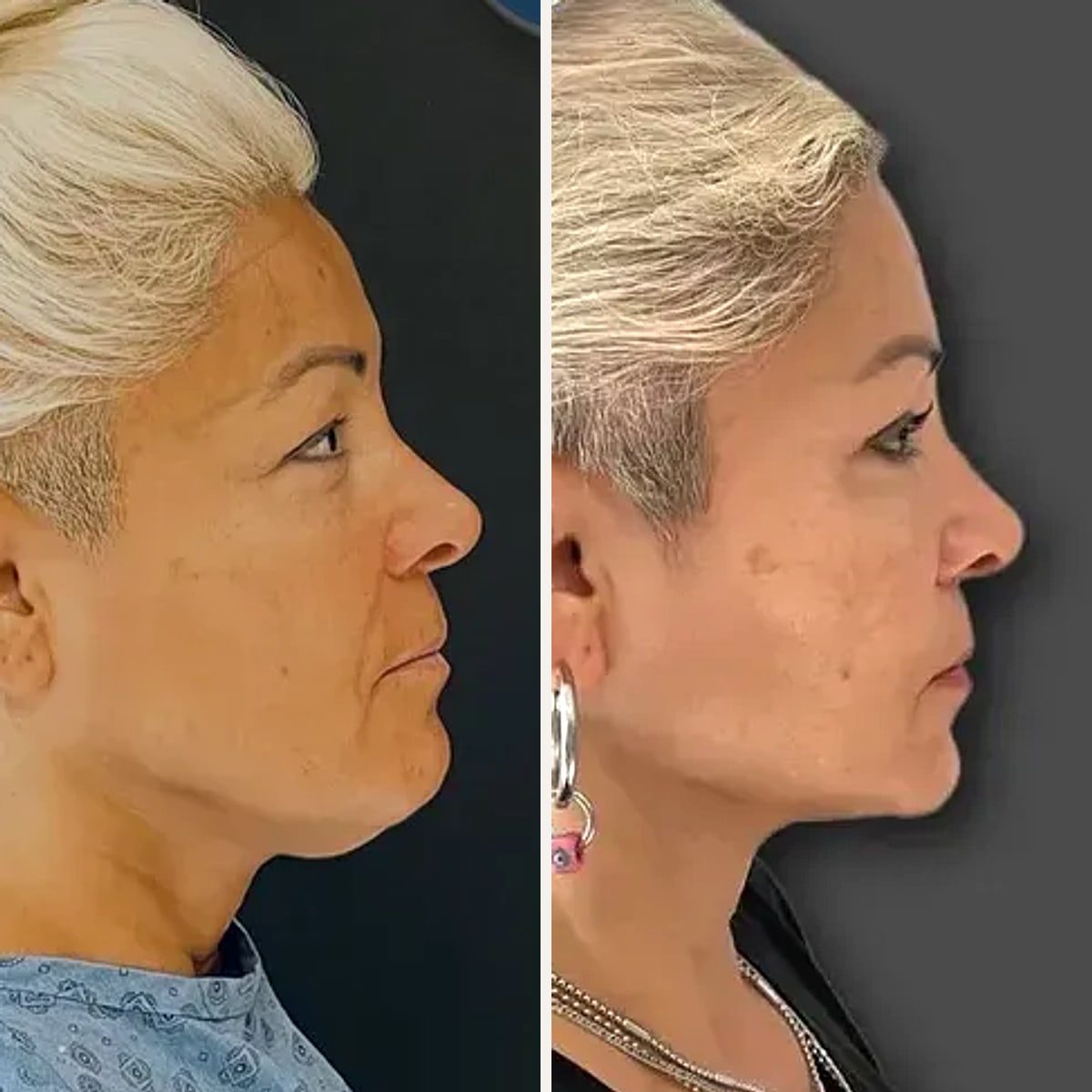 Before and after: Dr. Burak Ergün Tatar