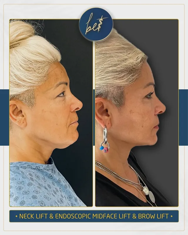Before and after deep plane facelift — -1-year-old patient, frontal view by Dr. Burak Ergün Tatar