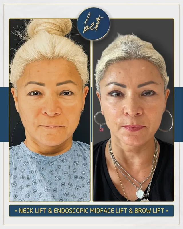 Before and after deep plane facelift — -1-year-old patient, frontal view by Dr. Burak Ergün Tatar