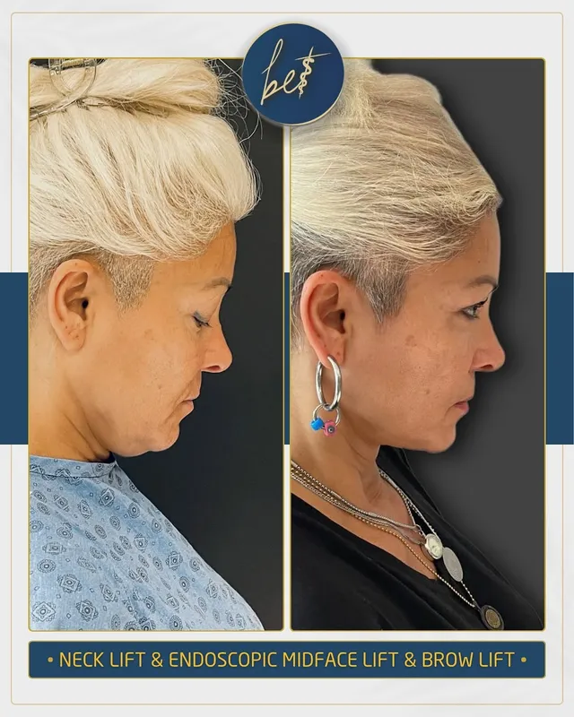 Before and after deep plane facelift — -1-year-old patient, frontal view by Dr. Burak Ergün Tatar