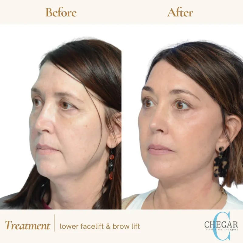 Before and after — Dr. Burke Chegar