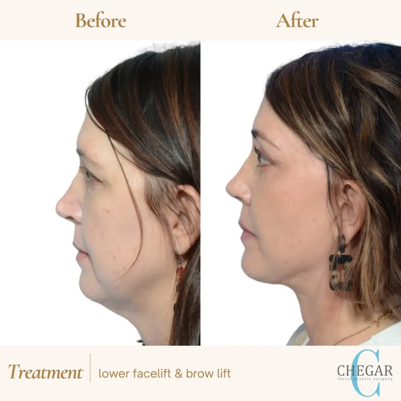 Before and after — Dr. Burke Chegar